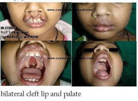 Cleft Lip Cleft Palate Repair Before After Delhi Dr Prabhash India