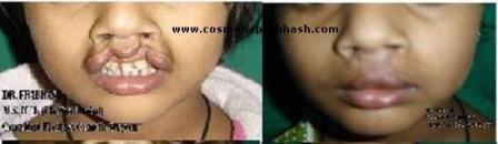 Bilteral Cleft Lip Repair Before After Delhi Dr Prabhash India