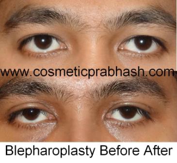 Blepharoplasty Before After Picture Delhi Dr Prabhash India.