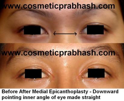 Asian Eyelid Surgery Delhi  Blepharoplasty Canthoplasty Before After India