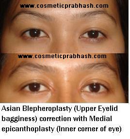 Blepharoplasty Before After Eyelid Surgery Delhi Dr Prabhash India.
