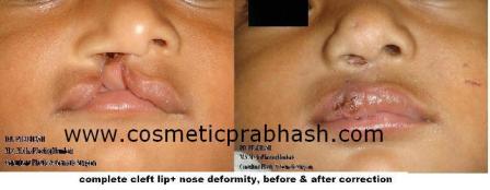 Cleft Lip Repair Delhi Dr Prabhash India