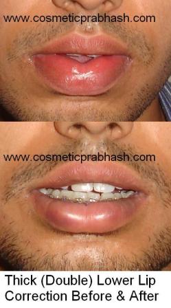 Thick Lip Reduction India Lower Lip Correction Delhi