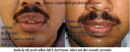 Thick Double Lip Reduction Surgery delhi Dr Prabhash India