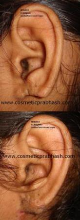 Ear lobe reconstruction Delhi Dr Prabhash India