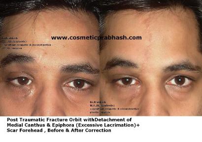 Eyelid Surgery Delhi Canthoplasty Eyebrow Scar correction before after India