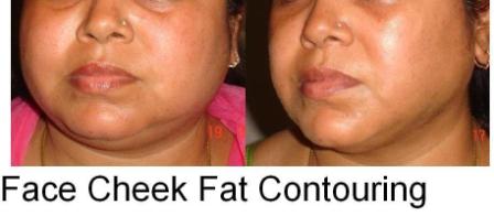 Face Liposuction in Delhi NCR India Face Lipo Before After Delhi