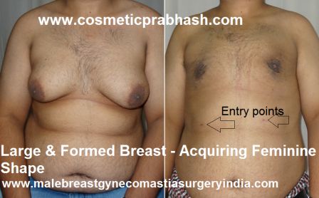 grade 3 gynecomastia surgery before after India Dr Prabhash Delhii