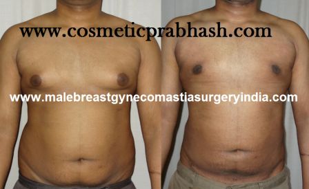 gynecomastia surgery India abdomen liposuction Delhi