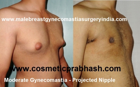 grade 2 Gynecomastia surgery before after India Dr Prabhash Delhi