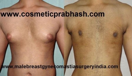 grade 2 gynecomastia male breast reduction before after India Dr Prabhash Delhi
