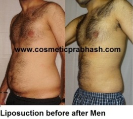 Male Stomach Liposuction Before After Delhi Dr Prabhash India