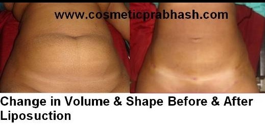 Liposuction Before After picture  Delhi Dr Prabhash India.