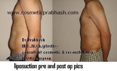 Stomach liposuction before after india Male belly Delhi