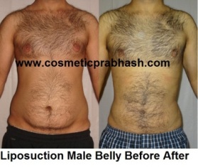 Liposuction before after Male belly Delhi Dr Prabhash India