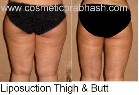 Hip Thigh Butt liposuction Delhi Thigh Fat Removal India
