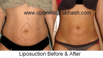 Liposuction cost in Delhi NCR India