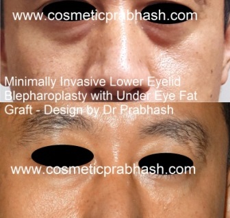 Minimally invasive lower eyelid blepharoplasty with under eye fat grafting before after Delhi Dr Prabhash India