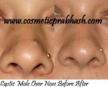 Mole Removal on Nose Delhi Dr Prabhash India
