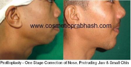 rhinoplasty-chin-enlargement-before-after-delhi