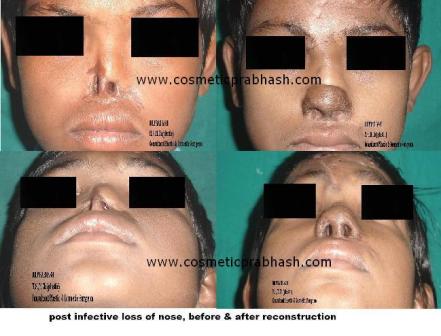 Reconstruction Rhinoplasty in India or Nose reconstruction with forehead flap Before After India Dr Prabhash Delhi.