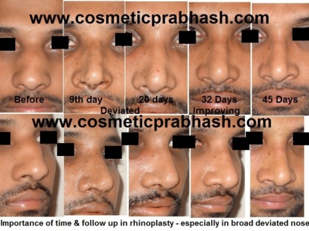 Rhinoplasty in India-  deviated nose massage before after Dr Prabhash Delhi.