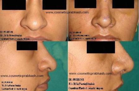  Nose beauty surgery in India - Delhi - low long nose droopy tip rhinoplasty before after picture.