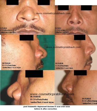 Rhinoplasty in India - Broken Nose Rhinoplasty Before After bone graft Dr Prabhash Delhi.