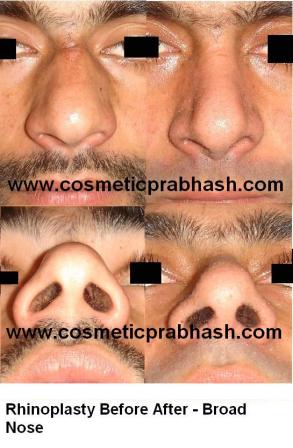 Best Big Nose Reduction Rhinoplasty  India, Delhi Dr Prabhash