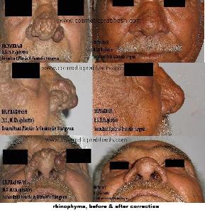 rhinoplasty in India - Rhinophyma or potato nose before after picture by Dr Prabhash Delhi.