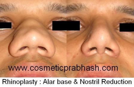 Rhinoplasty in India , Delhi Big Nose Rhinoplasty before after picture