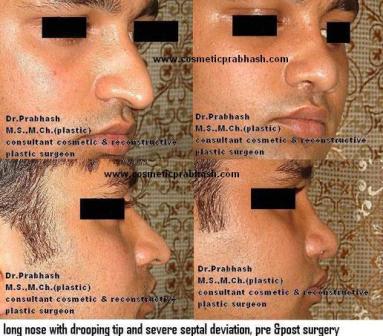 Rhinoplasty In India - Long droopy Nose tip Rhinoplasty Before After Delhi Dr Prabhash.