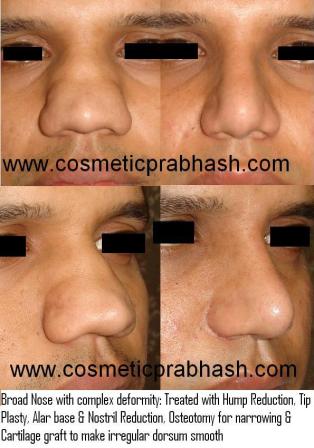 Rhinoplasty India Delhi Broad Big Nose Alar base reduction Before After by Dr Prabhash