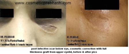 Scar Removal India Skin Grafting Delhi NCR
