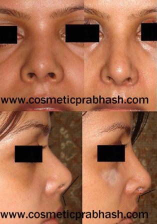 Rhinoplasty in India Short nose lengthening Before After by Dr Prabhash Delhi.