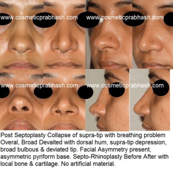  best Rhinoplasty surgeon in India, Delhi - Bulbous Hump Nose Surgery Before After by Dr Prabhash