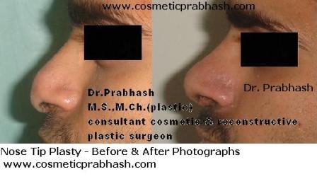best Rhinoplasty in Delhi Flat droopy nose tip correction India