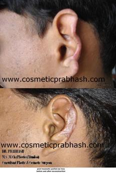 ear reconstruction rib cartilage graft Delhi Dr Prabhash India