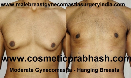 grade 1 saggy breast gynecomastia surgery  beore after picture India Dr Prabhash Delhi