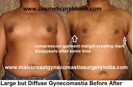 large diffuse gynecomastia surgery before after picture India Dr Prabhash Delhi