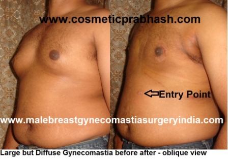 gynecomastia surgery large before after india 
