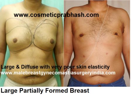 large gynecomastia male breast surgery before after India Dr Prabhash Delhi
