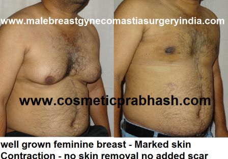 gynecomastia man boob surgery before after India Dr Prabhash Delhi