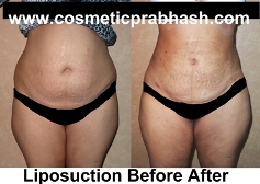 Abdomen Hips Liposuction Before After Delhi Dr Prabhash India.