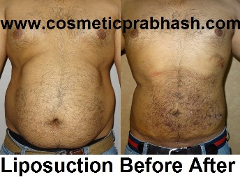 Liposuction Delhi  Liposuction Before After Picture