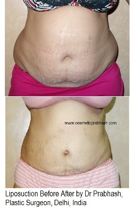 Best Liposuction surgery before after in Delhi, India by Dr Prabhash, Best Plastic Surgeon.