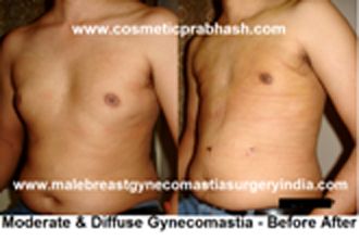 grade 2 gynecomastia surgery before after picture India Dr Prabhash Delhi
