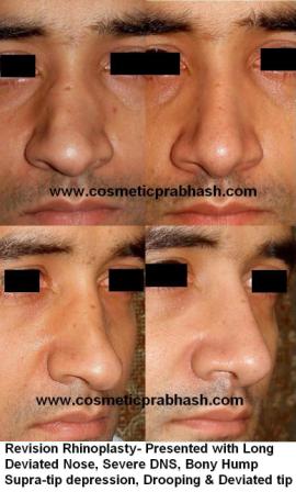 best Revision rhinoplasty India before after picture Dr Prabhash Delhi.