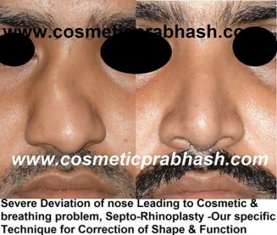 Best Rhinoplasty in Delhi Deviated Crooked Nose job Before After India Dr Prabhash.