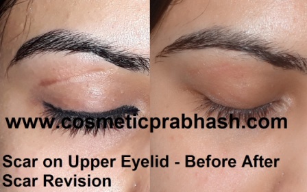 face scar removal delhi Eyelid scar treatment India dr Prabhash